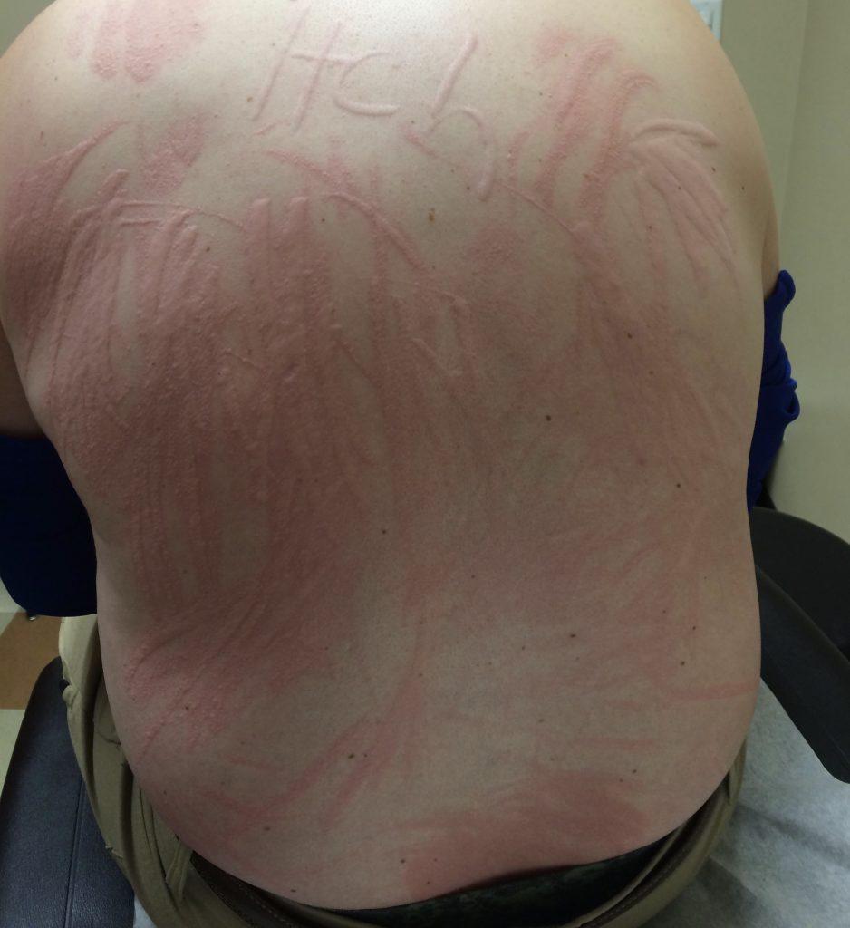 Image of Dermatographia Raised Red Marks on the Back