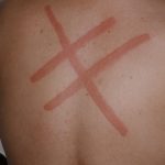 Picture of Red Mark on Back Because of Dermatographia