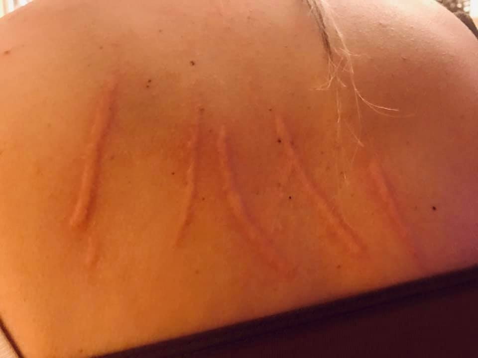 Causes of Dermatographia skin writing and treatment options