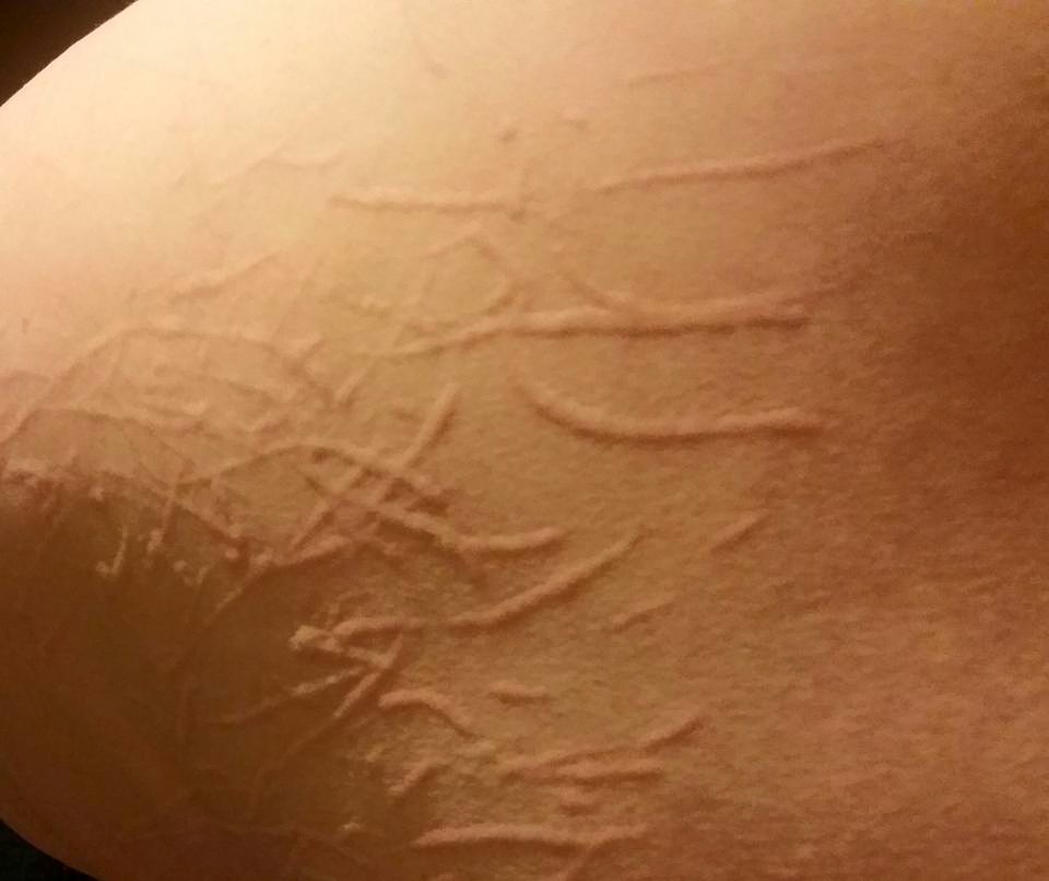 small skin scratches from dermatographia