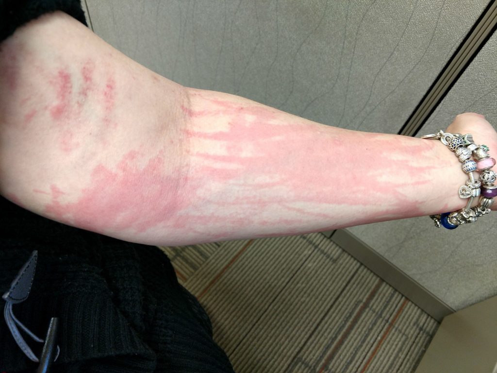image of dermatographia itching on the arm