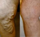 varices